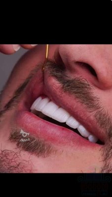 ایمپلنت از دم قسط فقط 11/900
